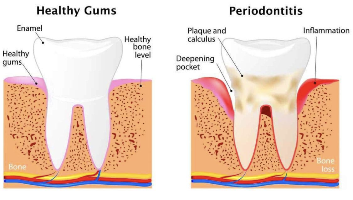 Dental X-ray showing calculus buildup