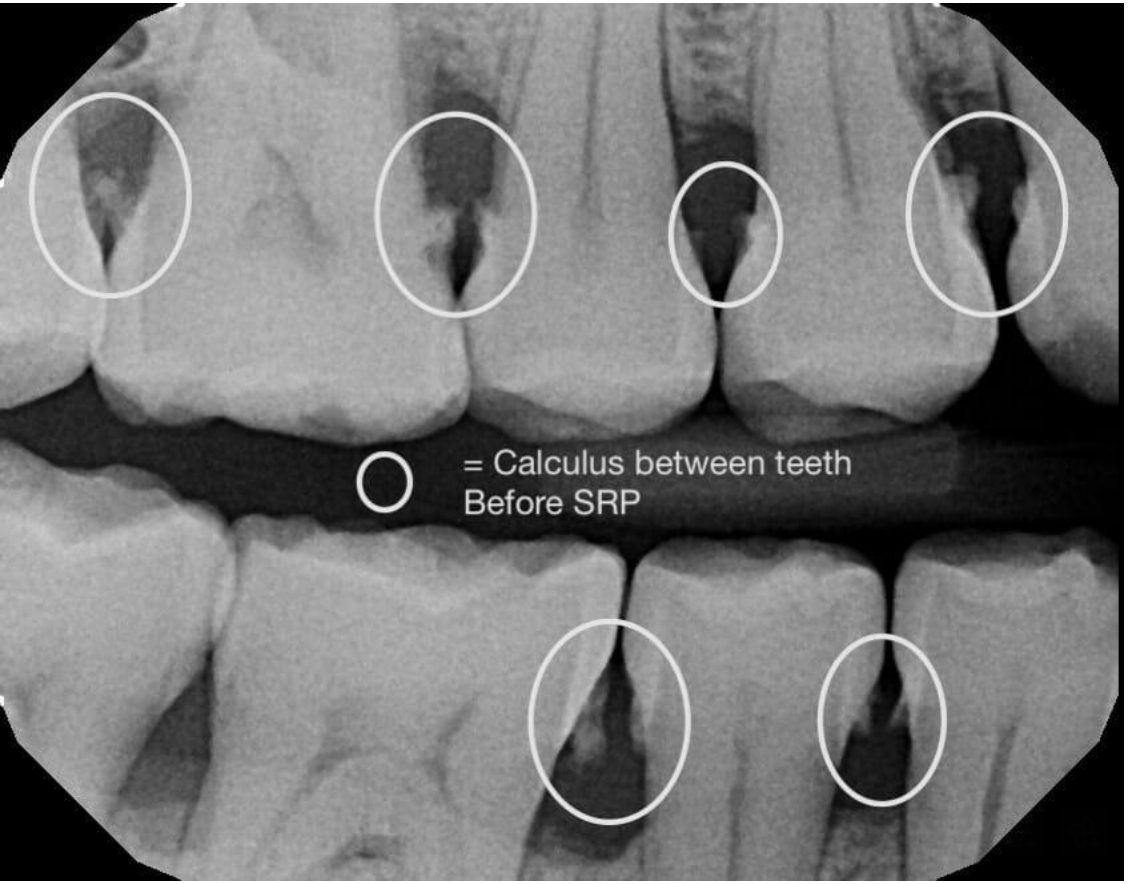 Radiograph showing heavy tartar deposits