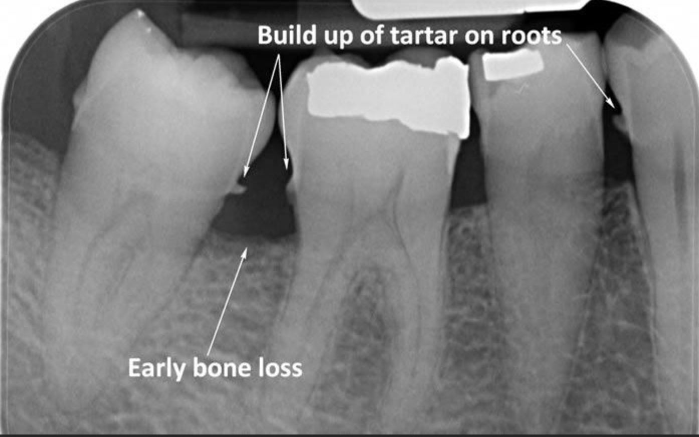 X-ray showing calculus buildup on root surfaces